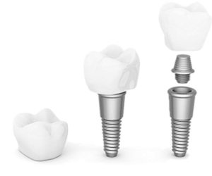 dental implant special home
