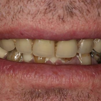 Before: Dental Implants
