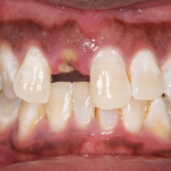 Before: Implant Retained Crown
