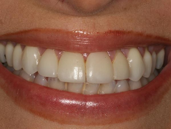 Before: Loose Front Teeth