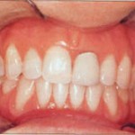 Figure 1. Preoperative maxillary left central incisor crown with dark gingiva.