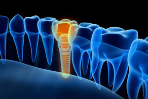 modern dental implants illustration