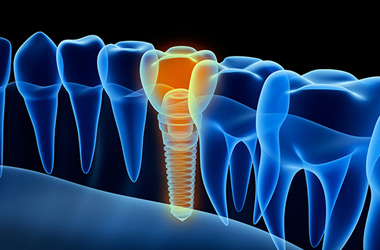 modern dental implants