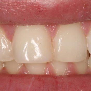 After: Laser Whitening