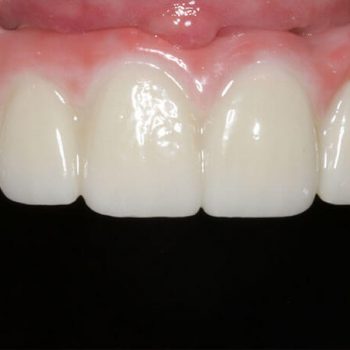 After: Hybrid After Placement of Dental Implants