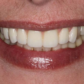 After: Placement of Dental Implants