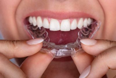 Woman inserting her clear aligners