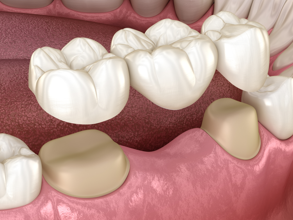 a dental bridge being placed.