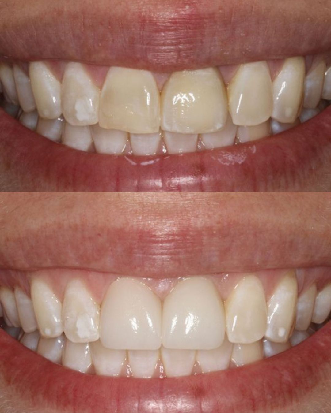 before and after bruxzir veneers