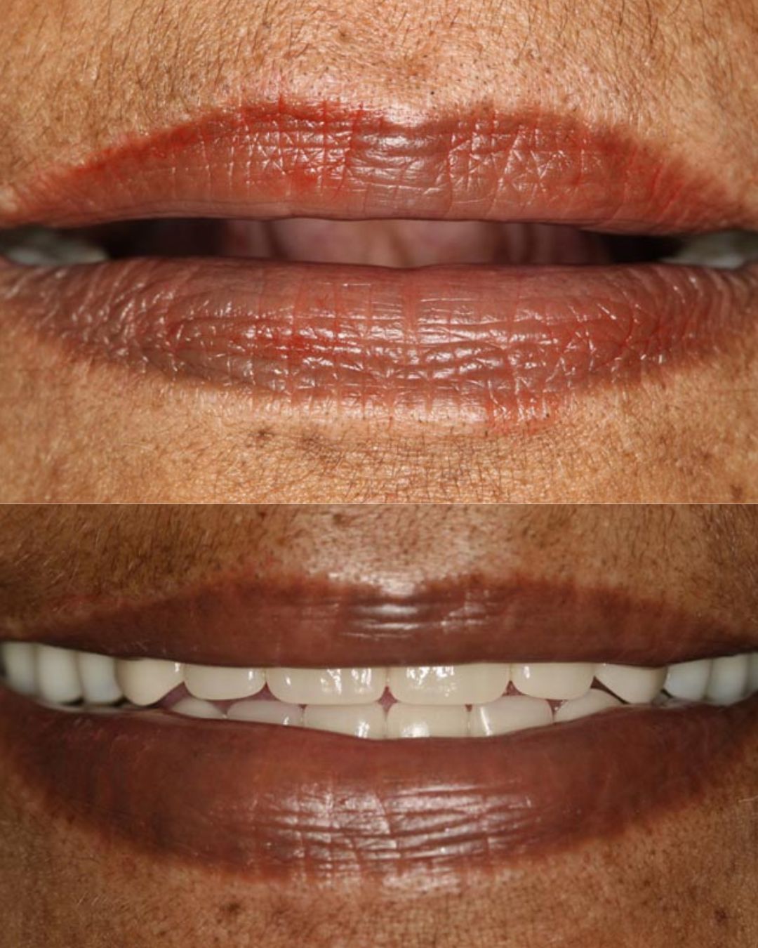 before and after overdentures