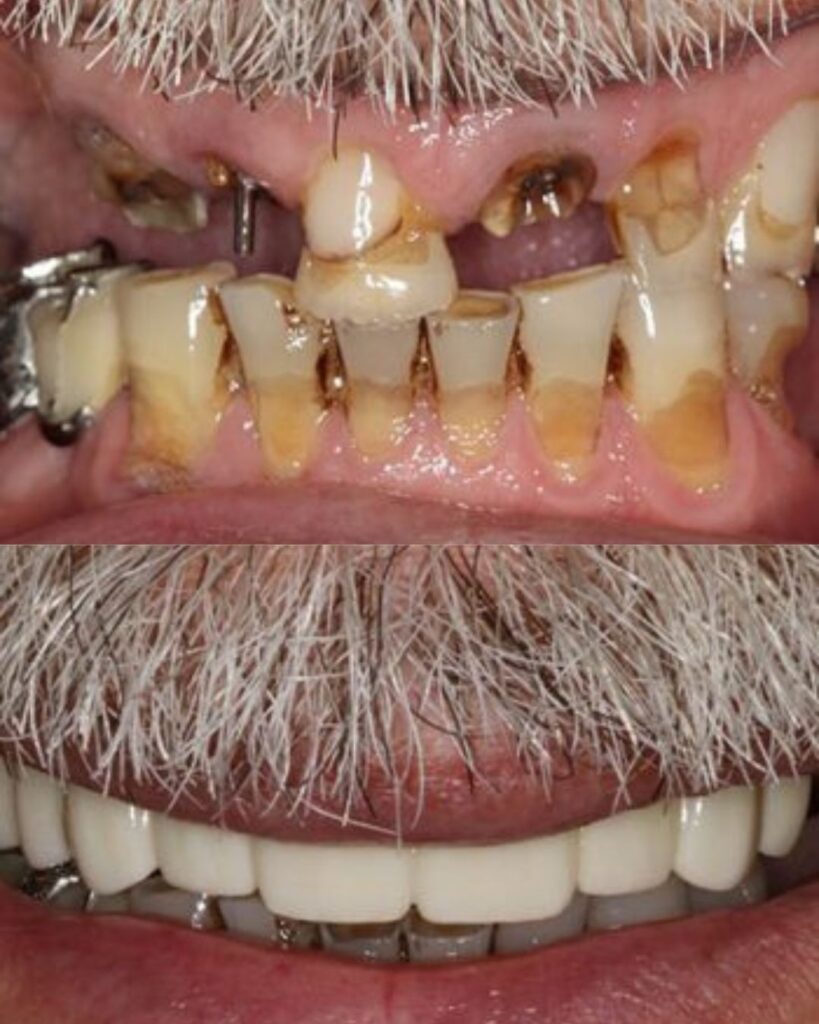 before and after dental bridges