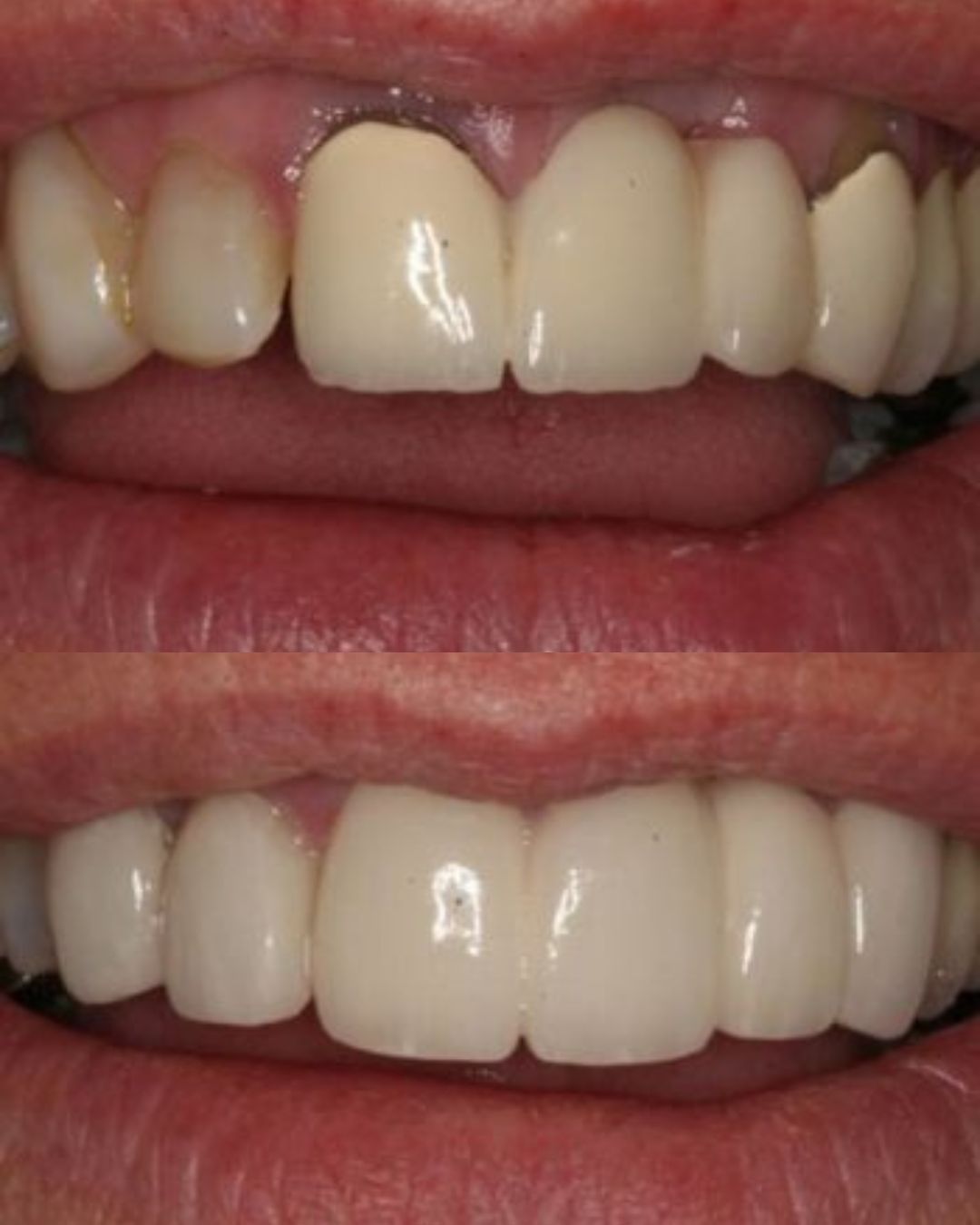 before and after dental bridges