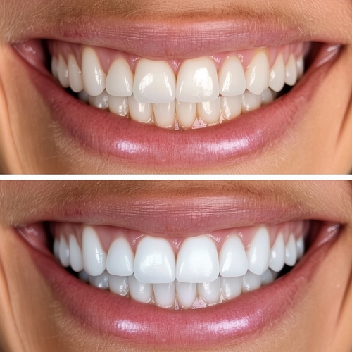 before and after teeth whitening