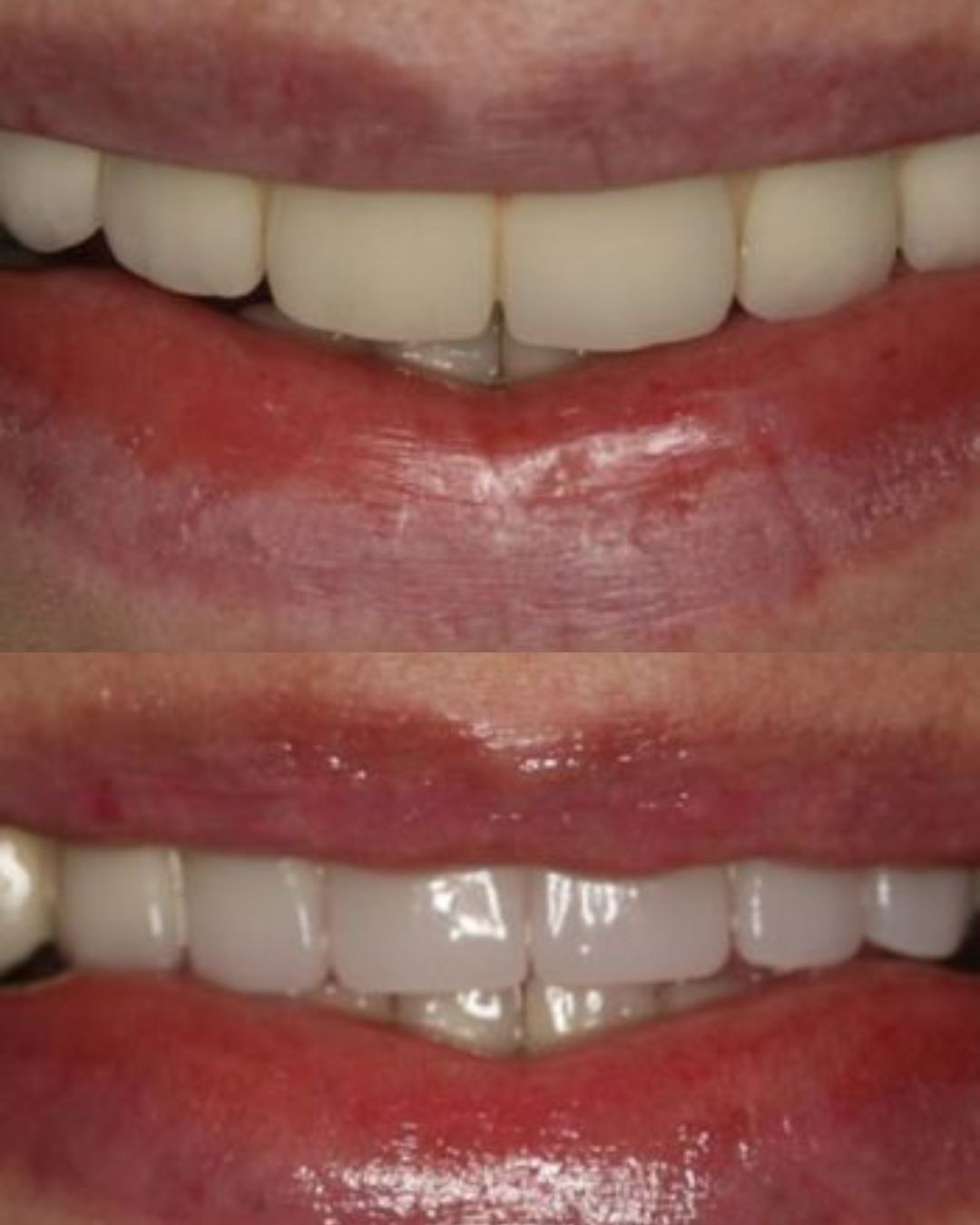 before and after dental implants